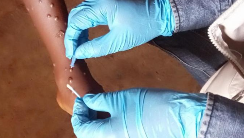 Mpox outbreak: Key steps 5 West African countries have rolled out